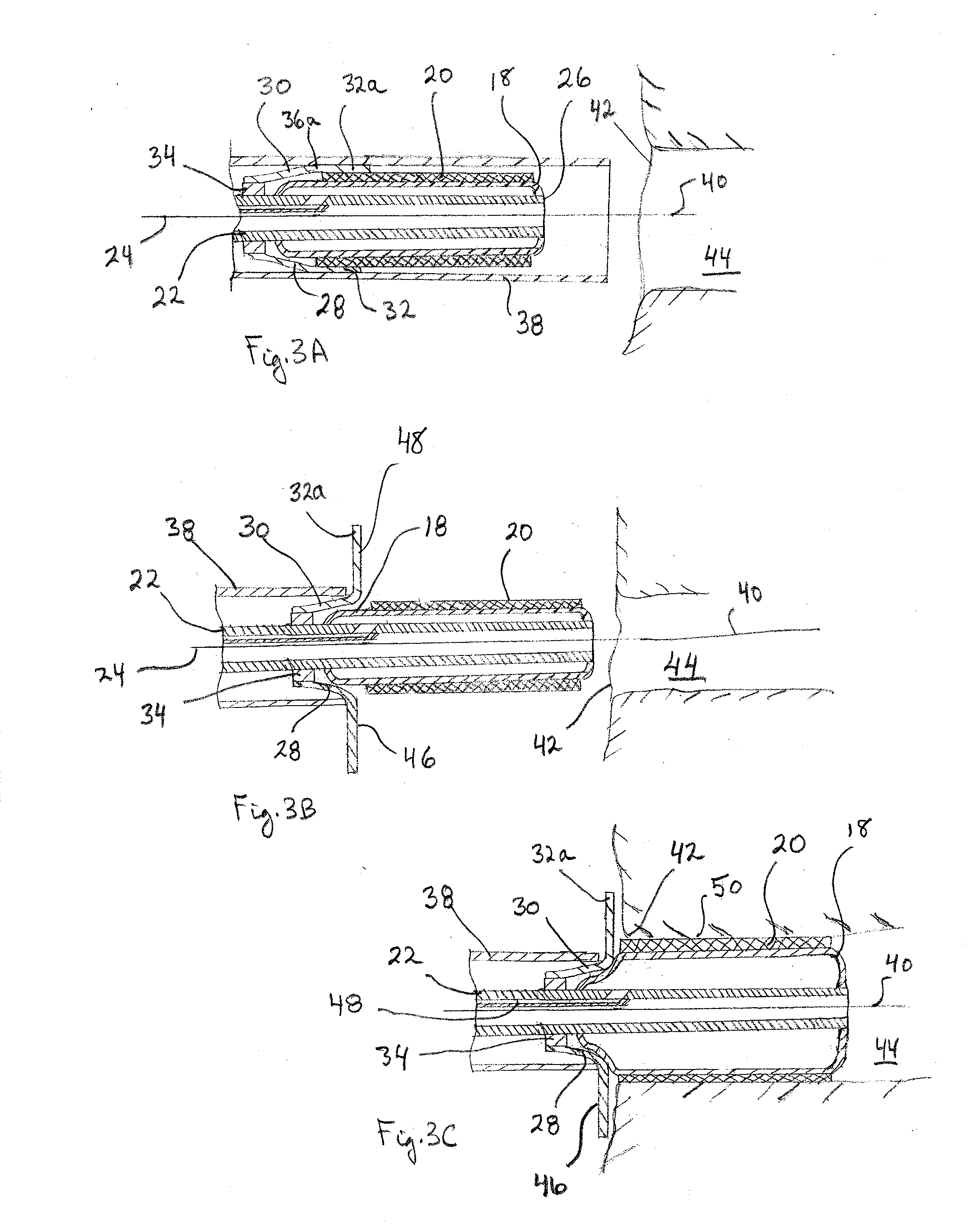 System and Method for Placing a Coronary Stent at the Ostium of a Blood Vessel