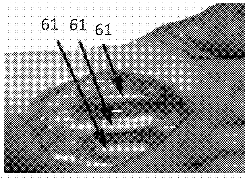 Negative Pressure Wound Therapy for Treatment of Periodontal Disease