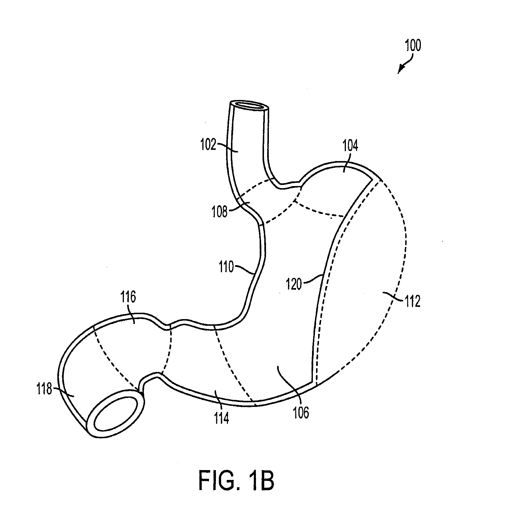 Gastric restriction devices for treating obesity