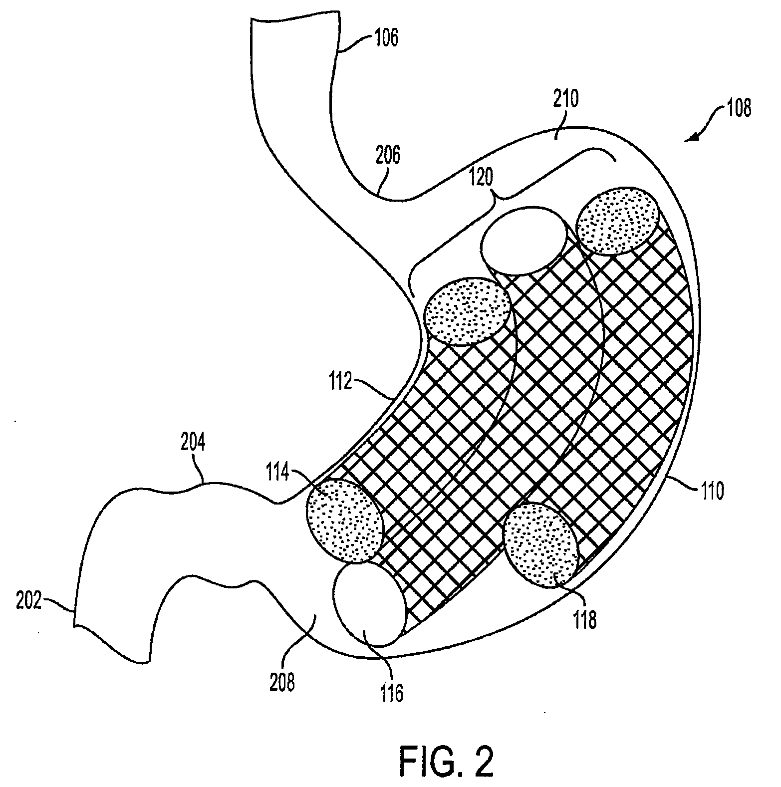 Method and apparatus for treating obesity and controlling weight gain using adjustable intragastric devices