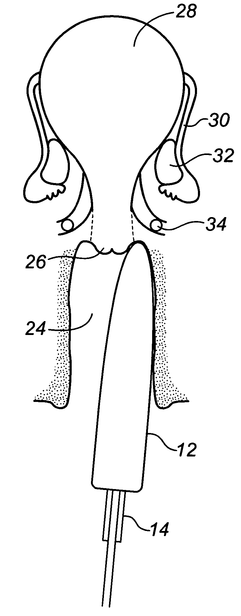 Method and apparatus for detecting endometriosis