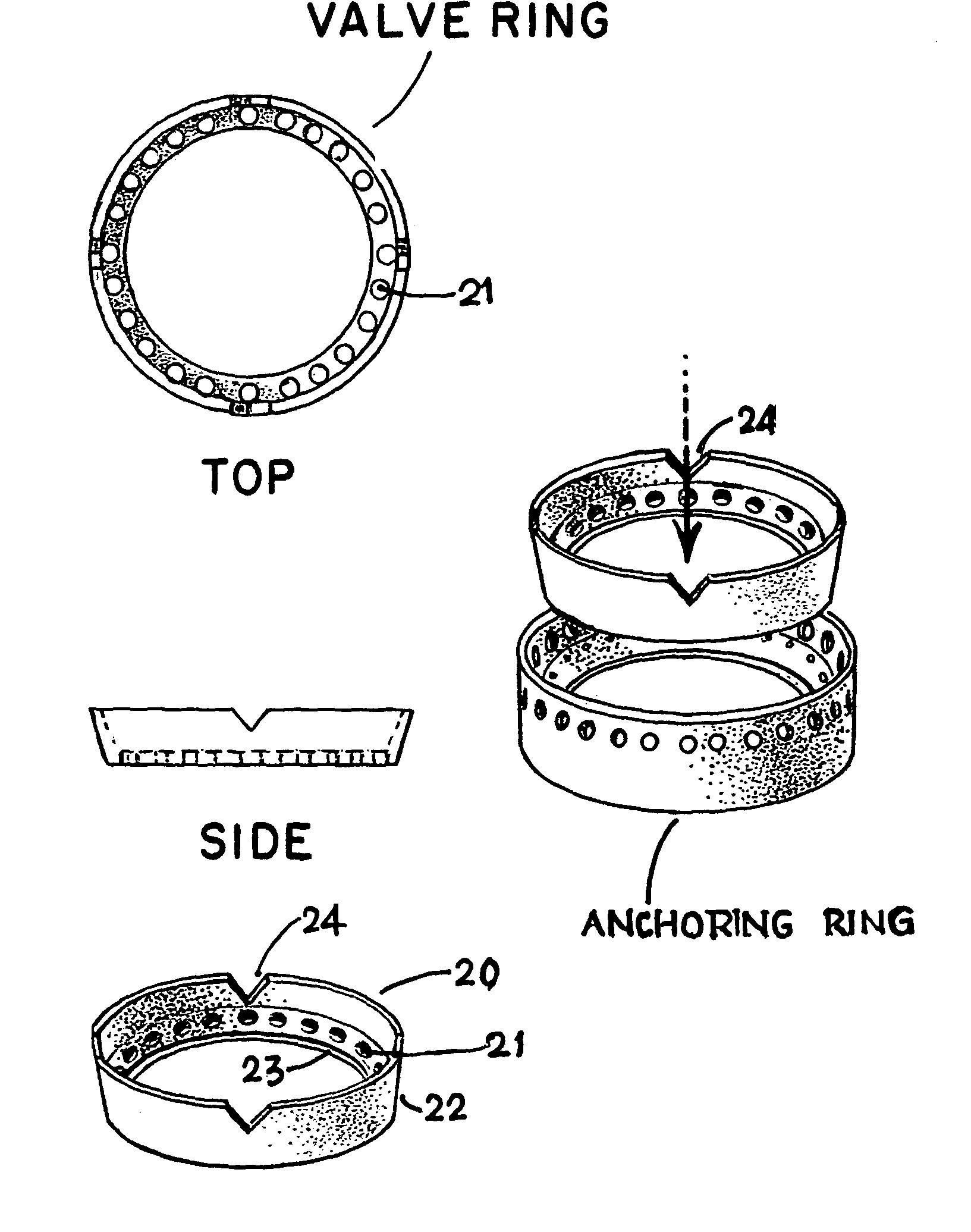 System and method for heart valve replacement