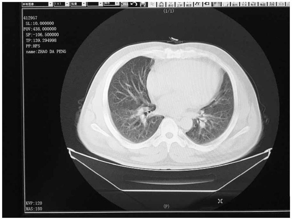 A kind of traditional Chinese medicine for treating pulmonary fibrosis and preparation method thereof