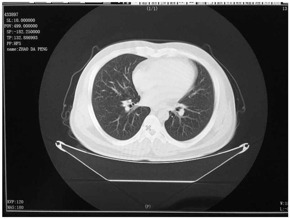 A kind of traditional Chinese medicine for treating pulmonary fibrosis and preparation method thereof