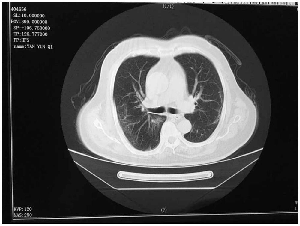 A kind of traditional Chinese medicine for treating pulmonary fibrosis and preparation method thereof