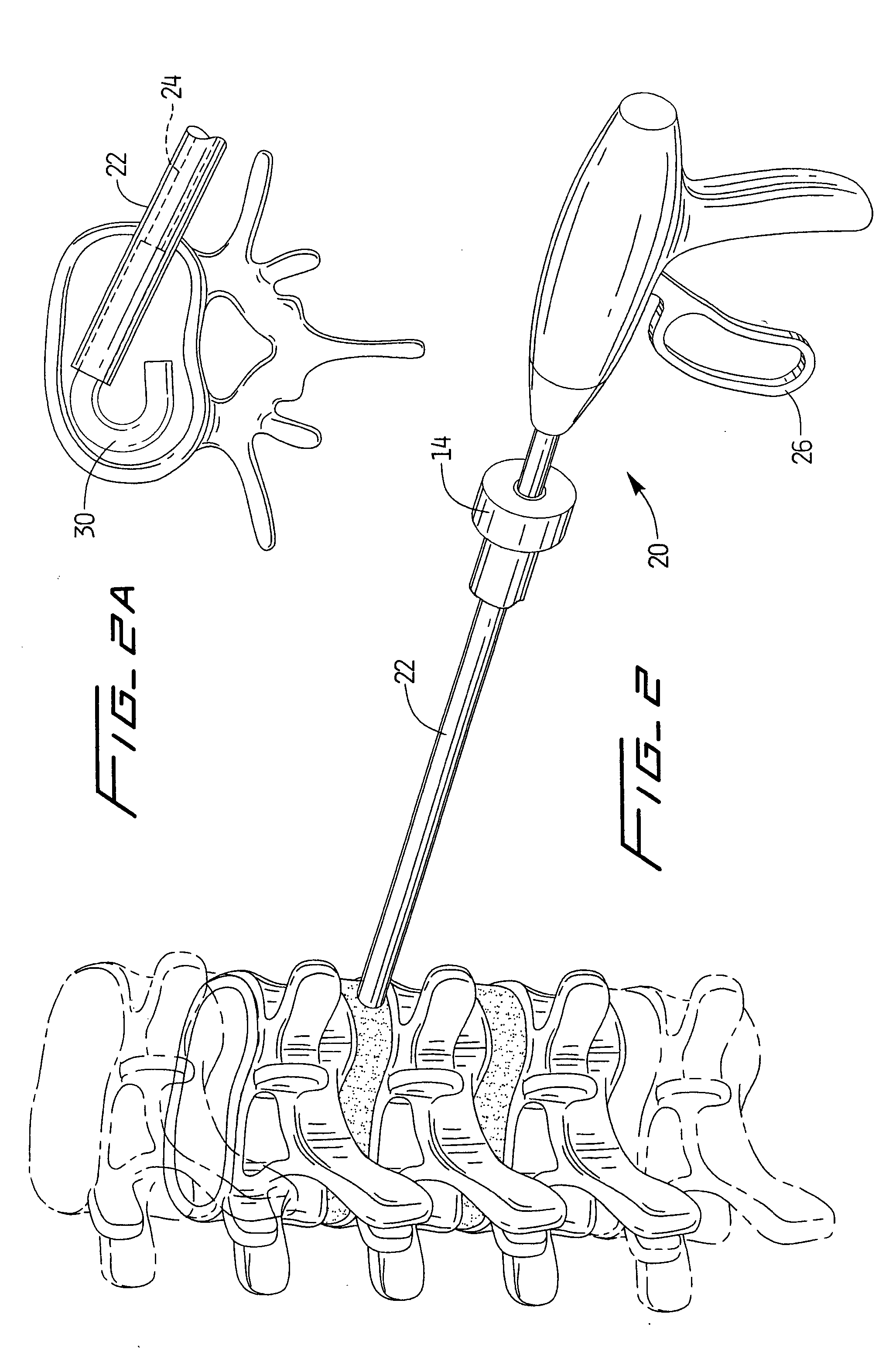 Spinal implant and method of use