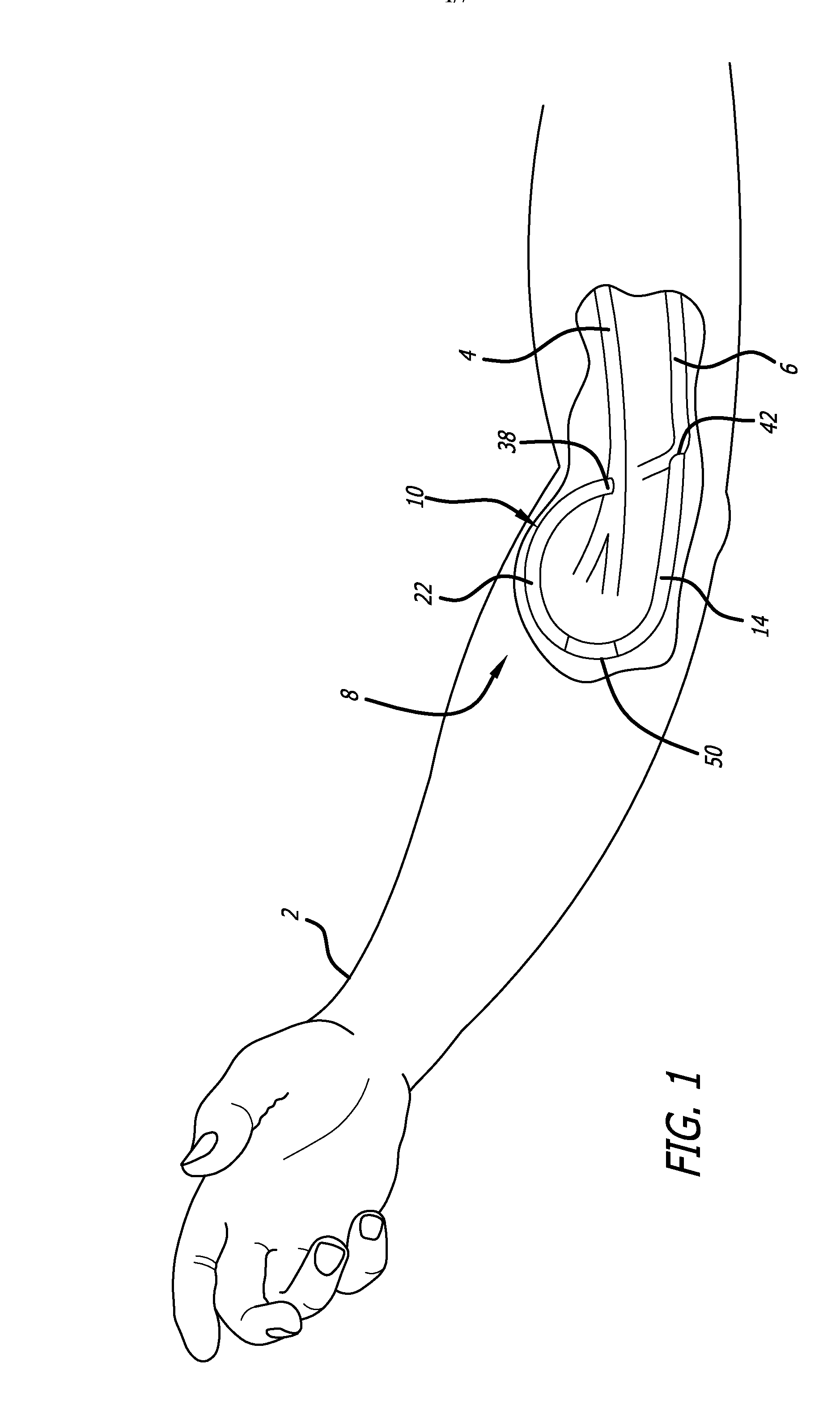 Vascular graft prosthesis with selective flow reduction
