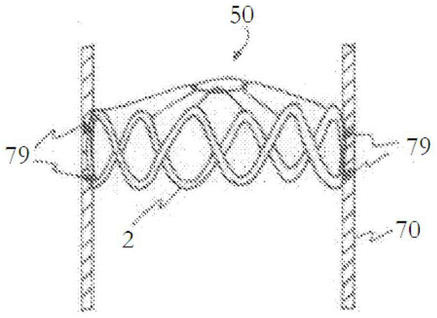 absorbable vascular filter