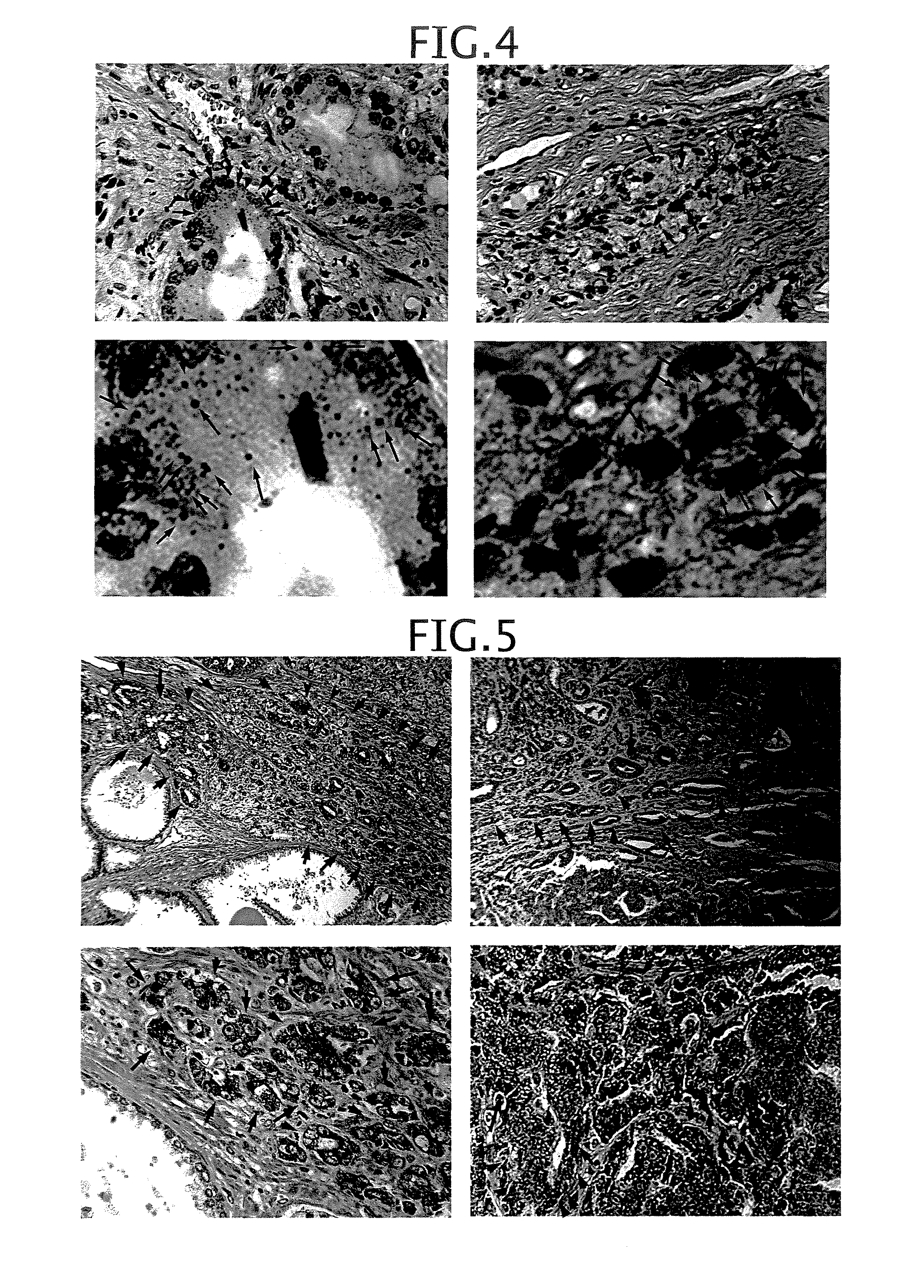 Method and composition for detecting cancer by means of detection of Epstein-Barr virus nuclear antigen 2 coactivator P100