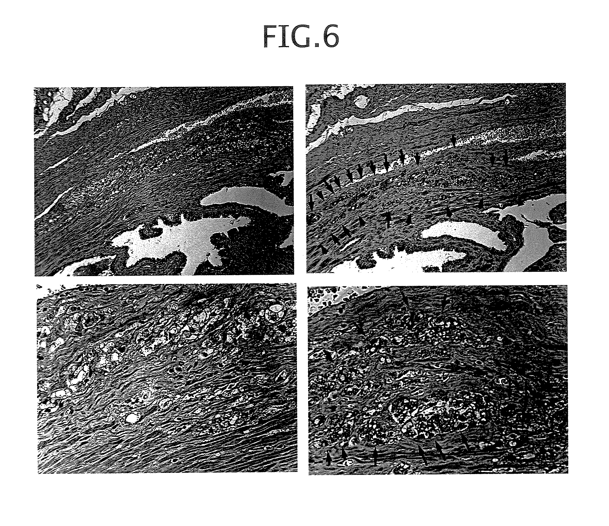 Method and composition for detecting cancer by means of detection of Epstein-Barr virus nuclear antigen 2 coactivator P100