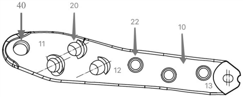 A locking plate for femoral neck fracture reduction