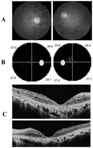 Retinitis pigmentosa mutant site and application thereof