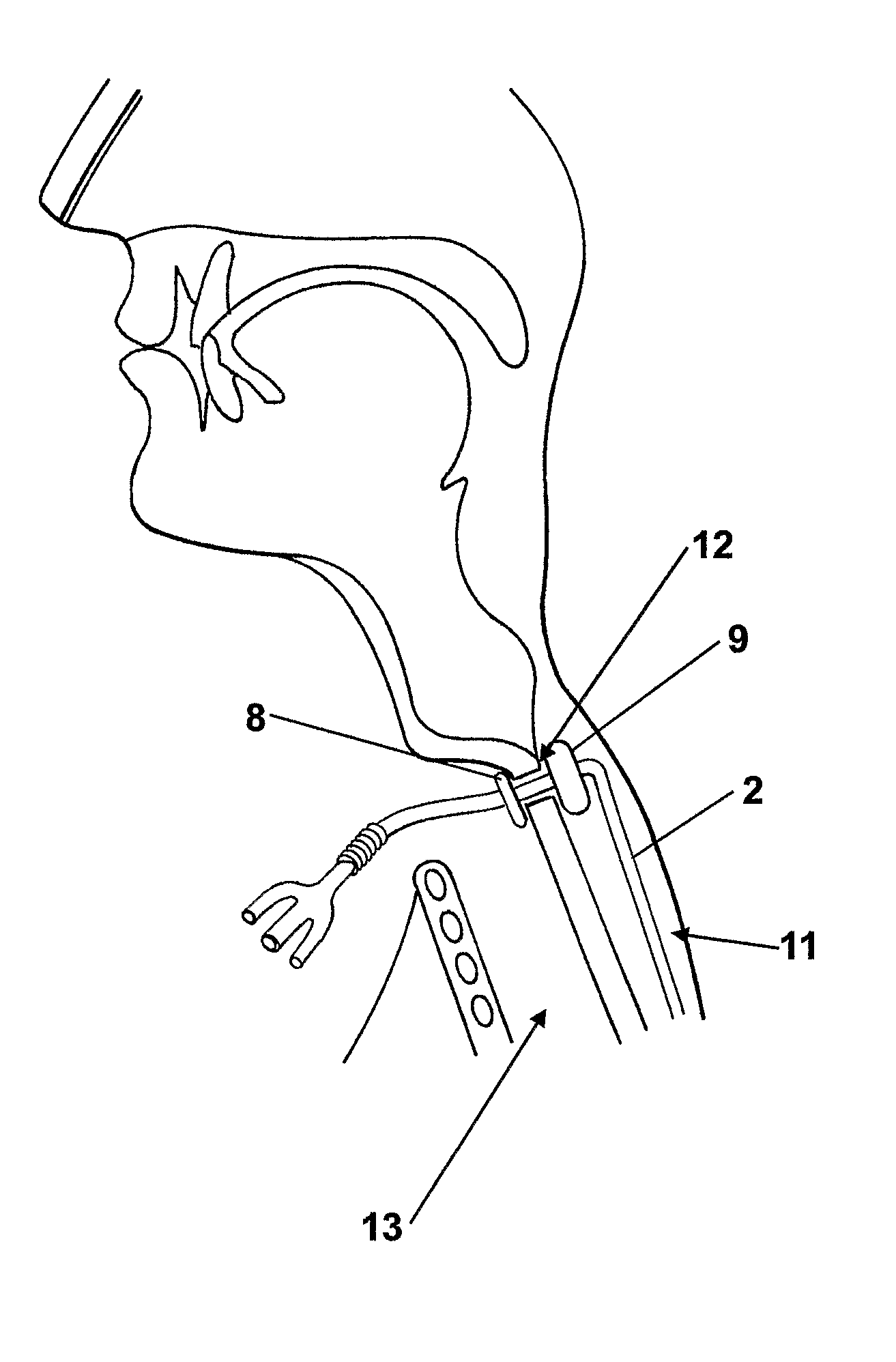 Catheter