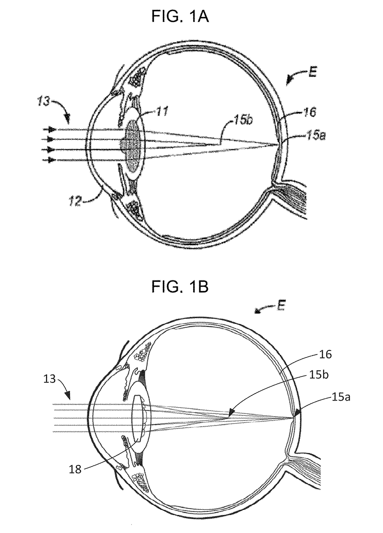 Intraocular lenses for presbyopia treatment