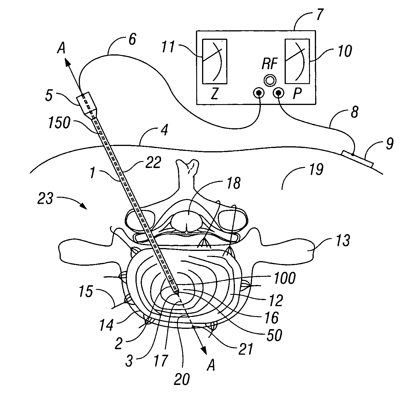 Method and apparatus for monitoring disc pressure during heat treatment of an intervertebral disc