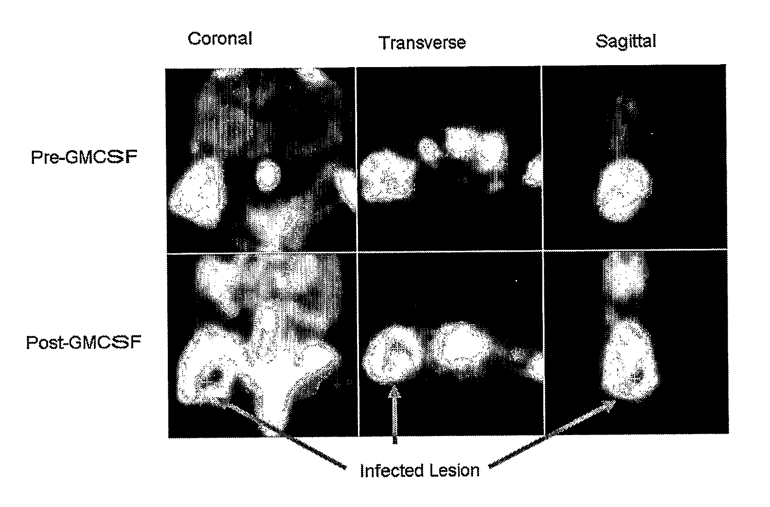 Methods of Detection and Therapy of Inflamed Tissues Using Immune Modulation