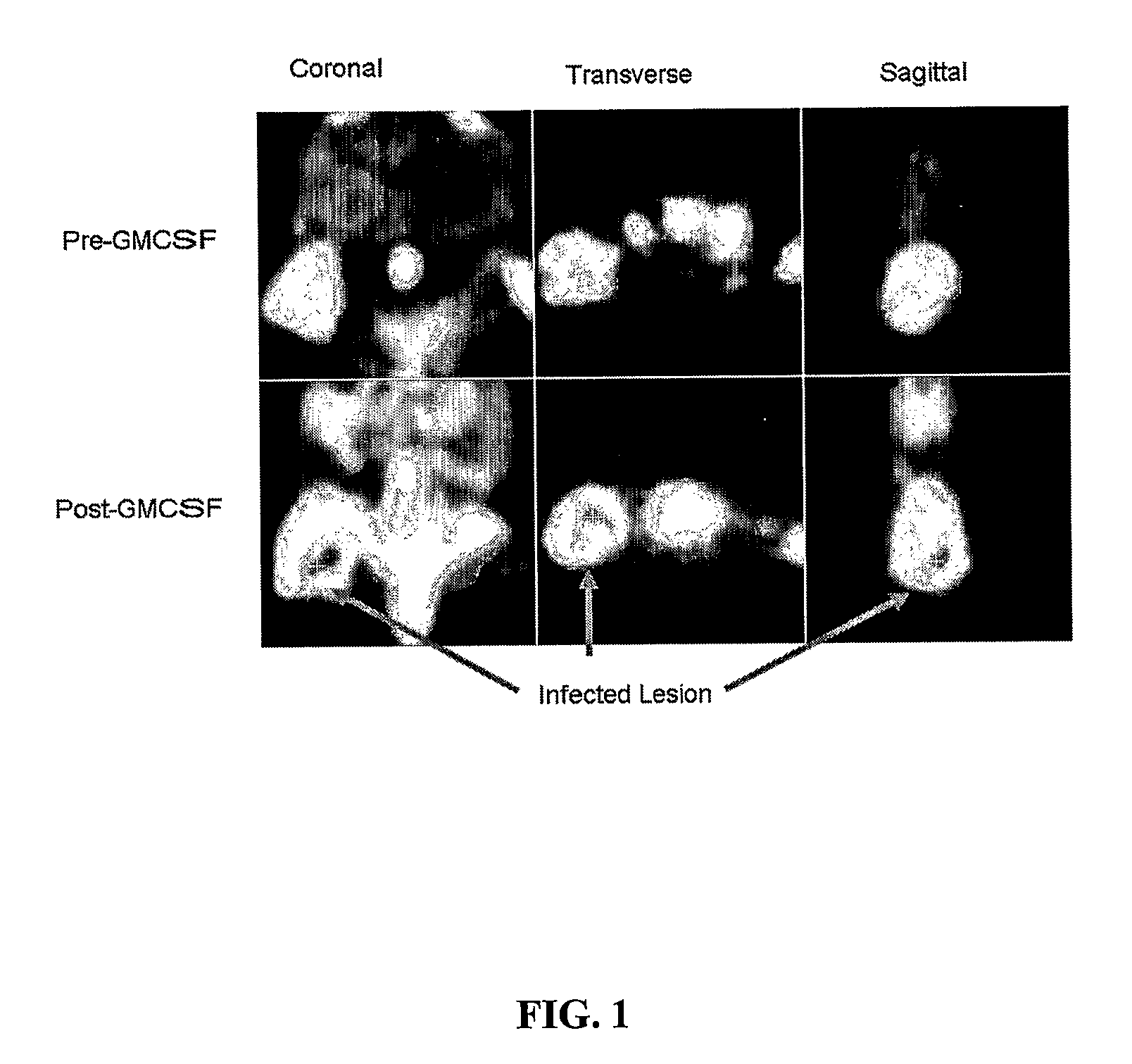 Methods of Detection and Therapy of Inflamed Tissues Using Immune Modulation