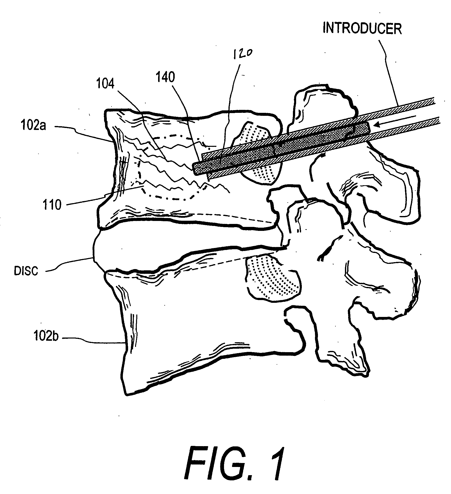 Implants and methods for treating bone
