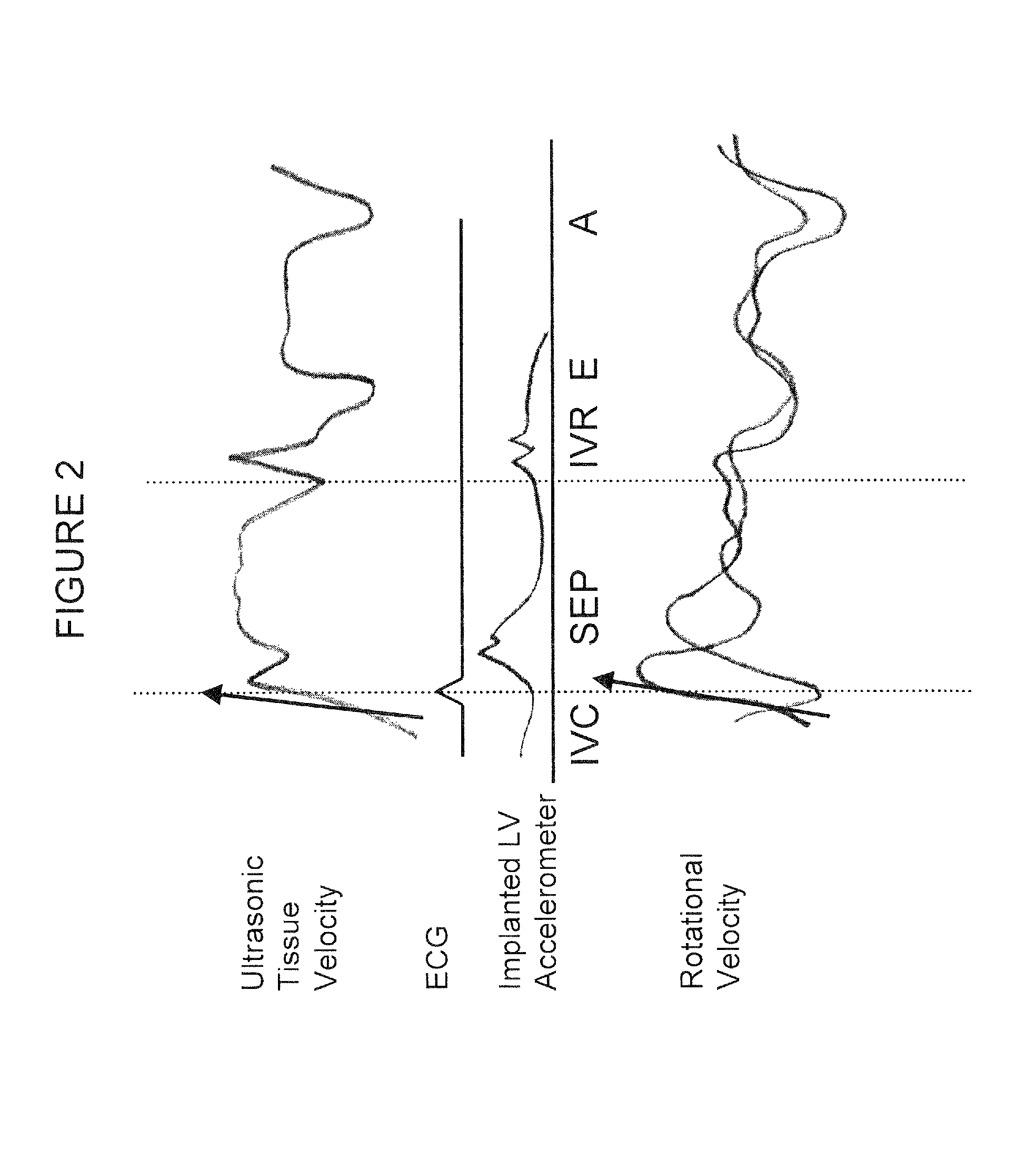 Method and apparatus for defining the effect of atrial arrhythmias on cardiac performance and directing therapy using a plurality of intrinsically and extrinsically derived signals