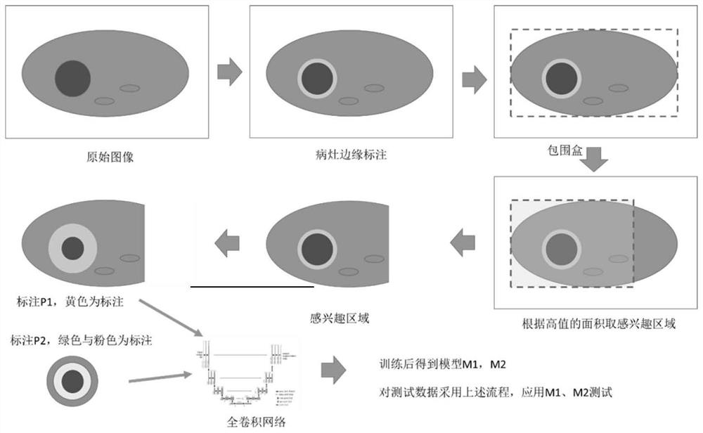 Full-automatic detection and segmentation method and system for common bile duct cyst lesions in abdominal CT