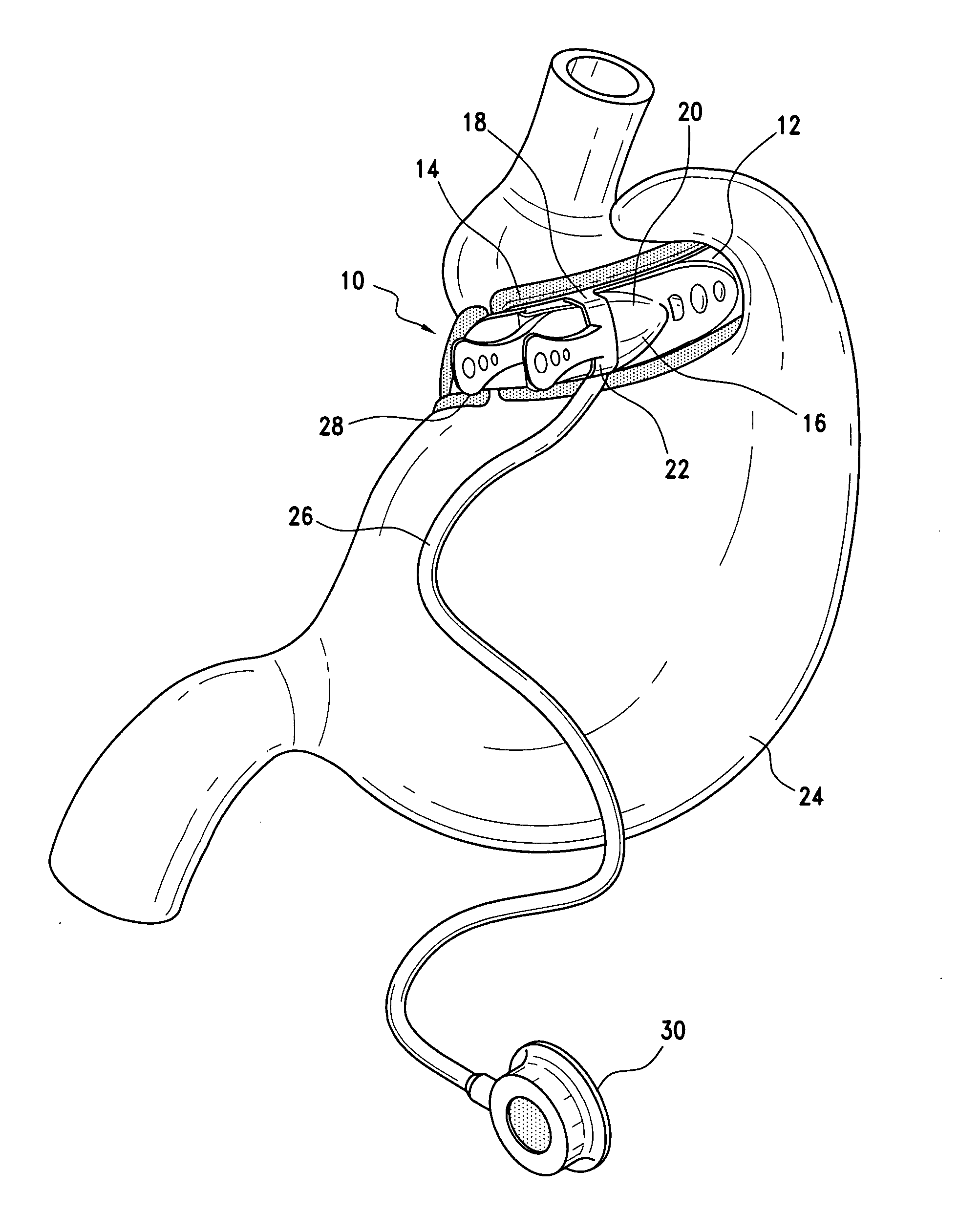Gastric band with supply tube check valve