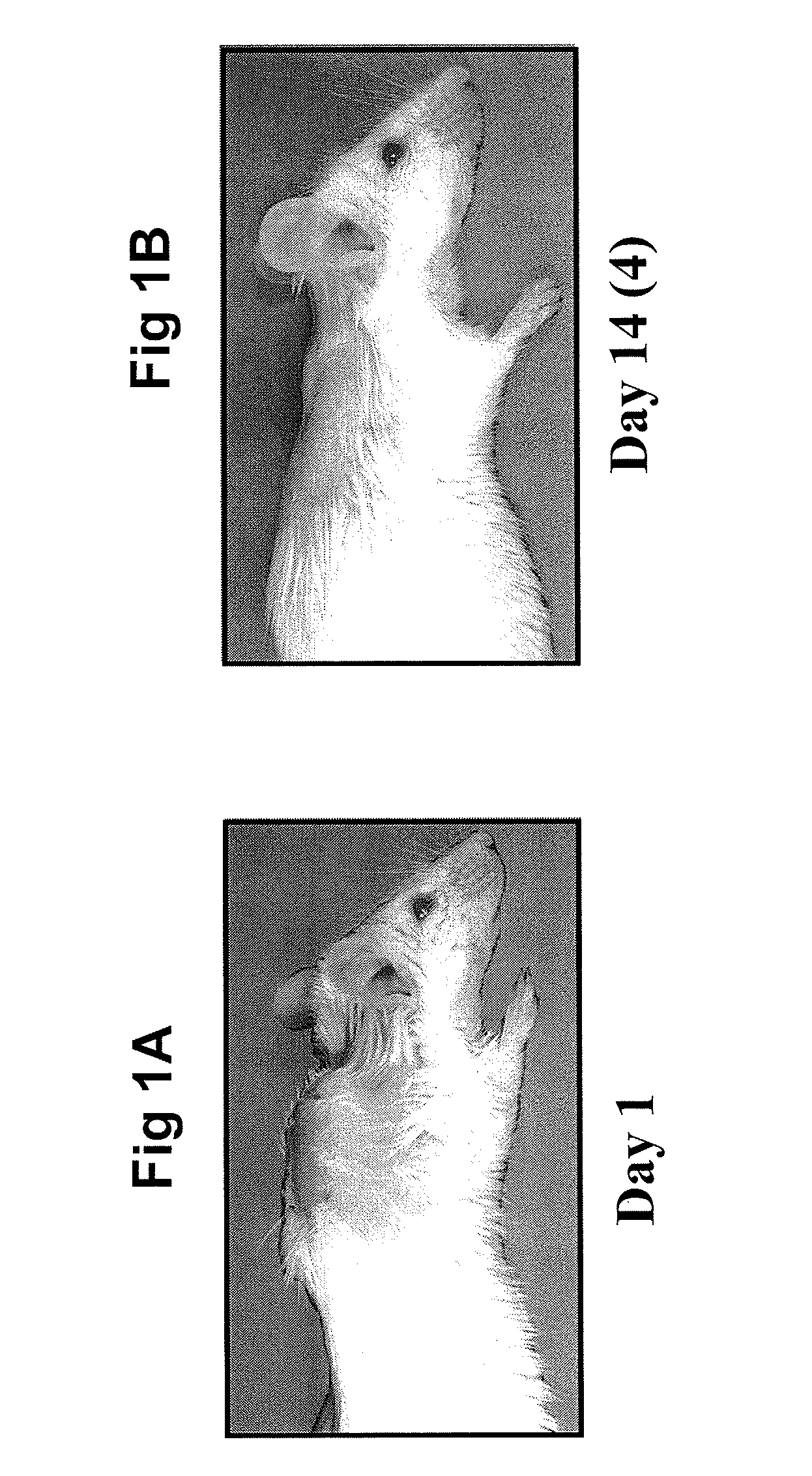 Methods for amyloid removal using anti-amyloid antibodies