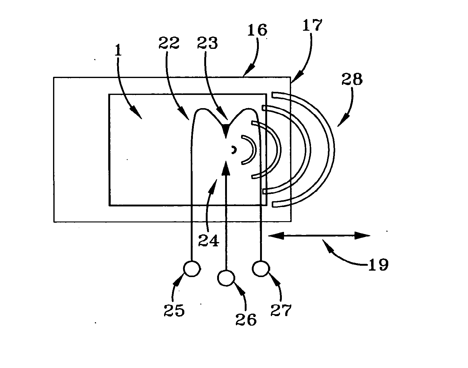 Method of acoustic shock wave treatments for complications associated with surgical mesh implants