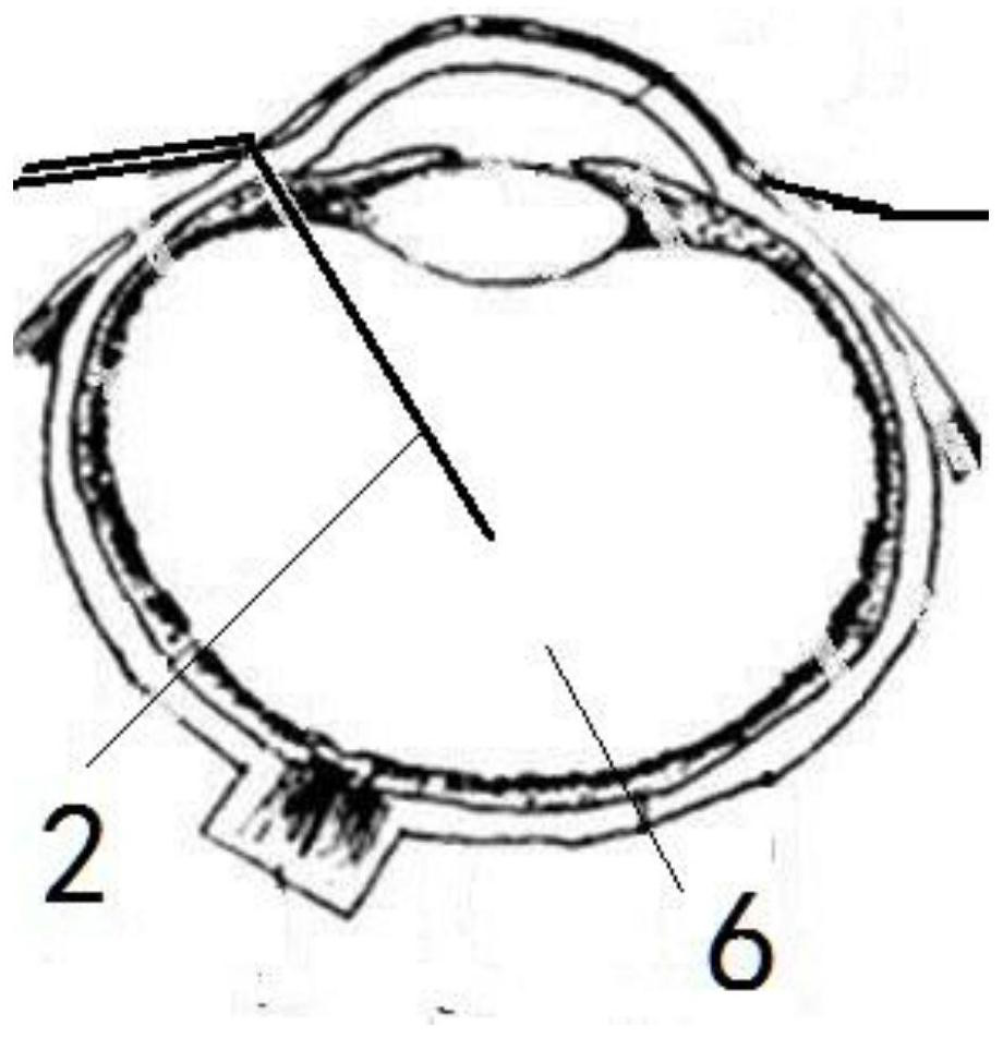 Pressure regulating device for posterior segment of eyes in penetrating keratoplasty