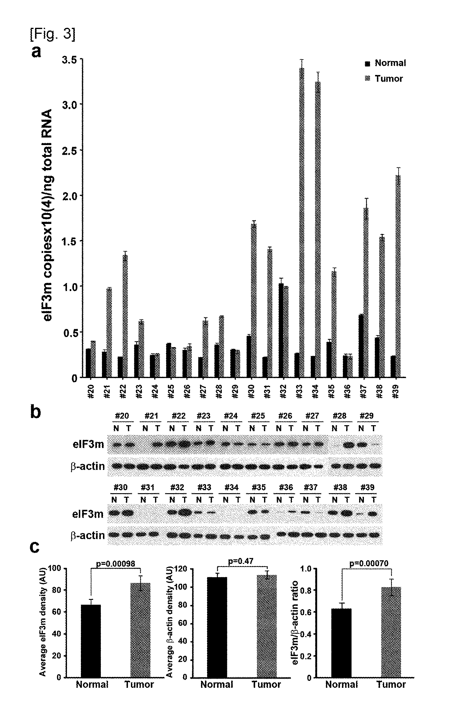 Use of eif3m for the diagnosis and treatment of cancer