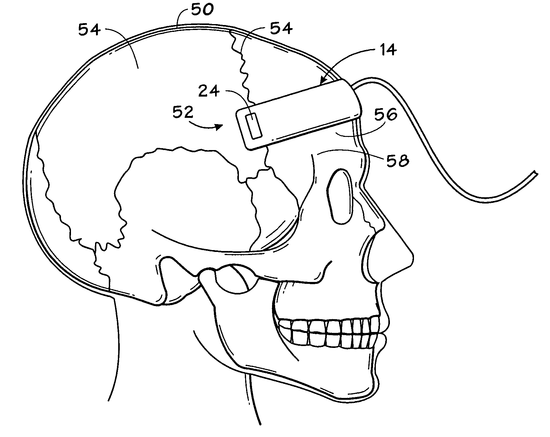 System and method for detection of brain edema using spectrophotometry