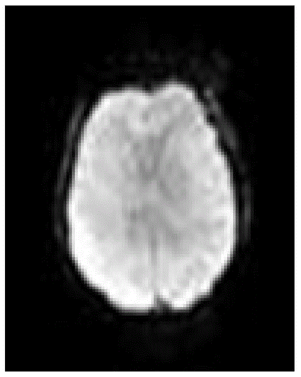 Data processing method based on rfMRI (resting-state functional magnetic resonance imaging) of idiopathic epilepsy