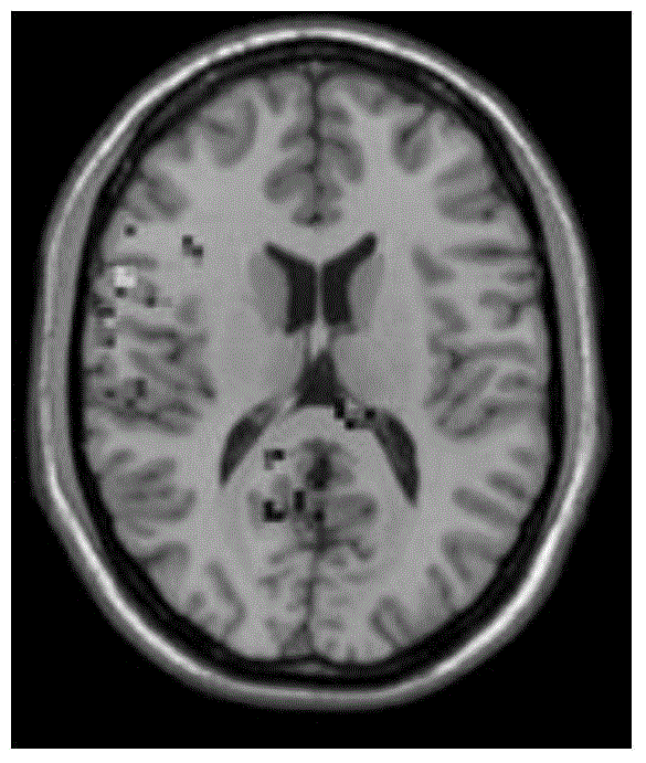 Data processing method based on rfMRI (resting-state functional magnetic resonance imaging) of idiopathic epilepsy
