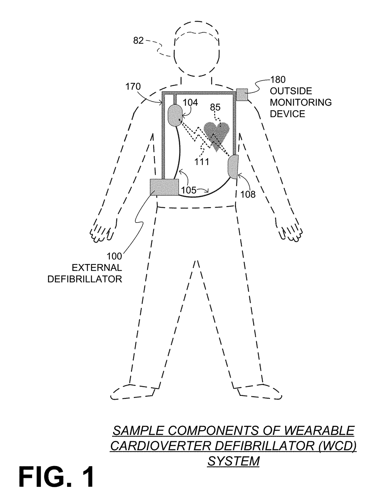 Wearable cardioverter defibrillator (WCD) system reacting to high-amplitude ECG noise