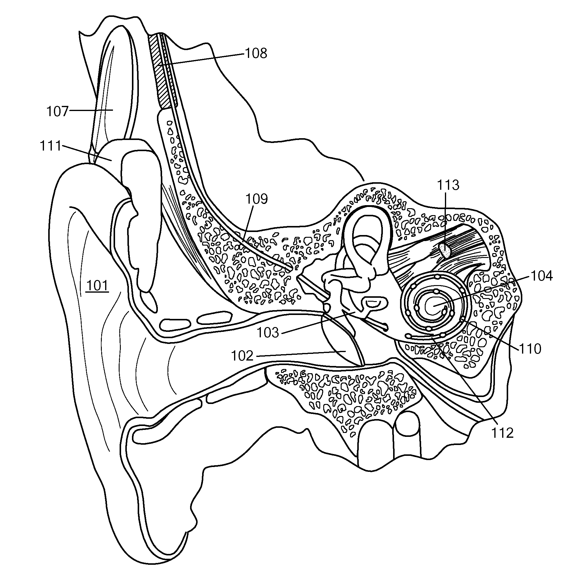 Enhancing Fine Time Structure Transmission for Hearing Implant System