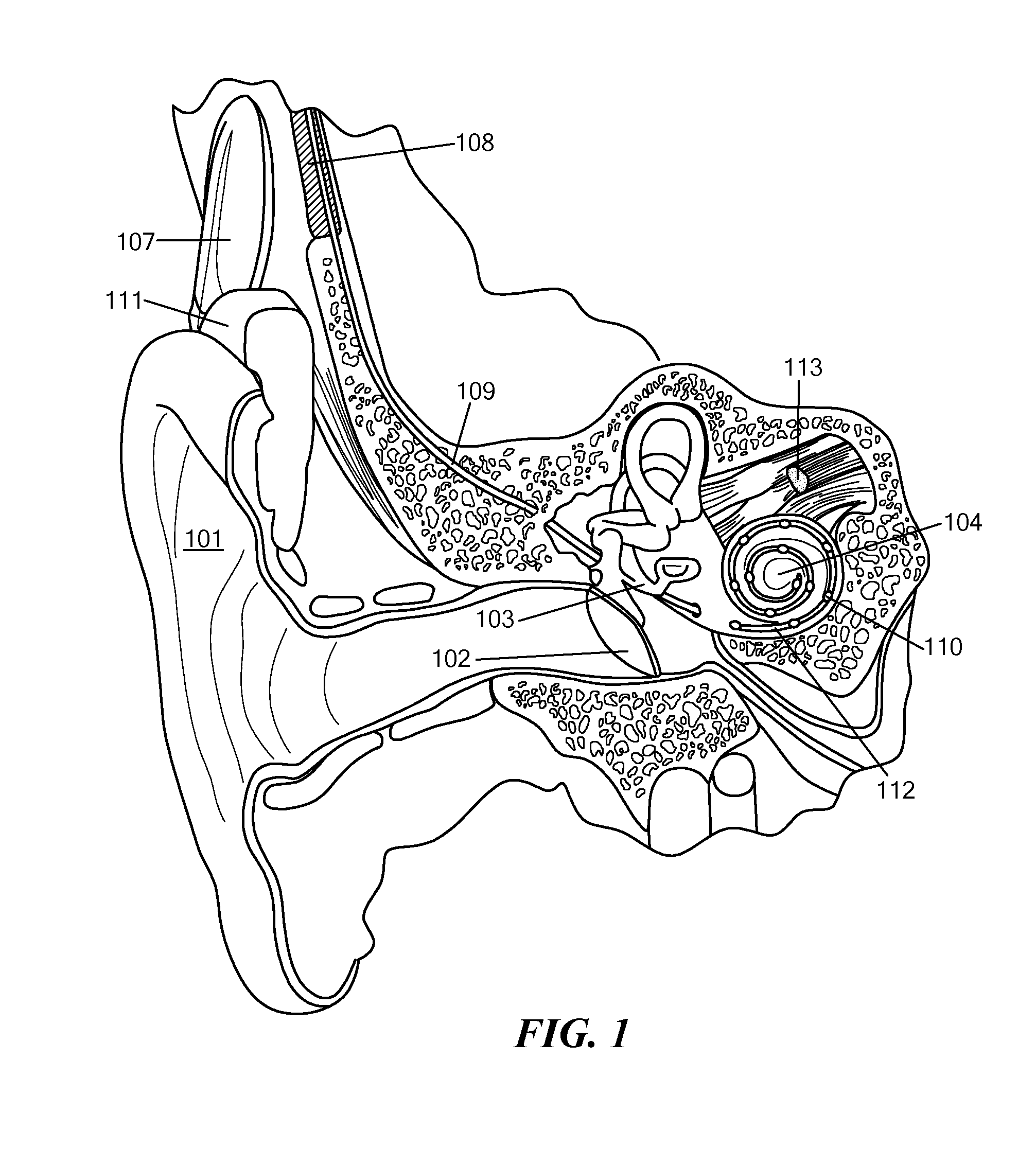 Enhancing Fine Time Structure Transmission for Hearing Implant System