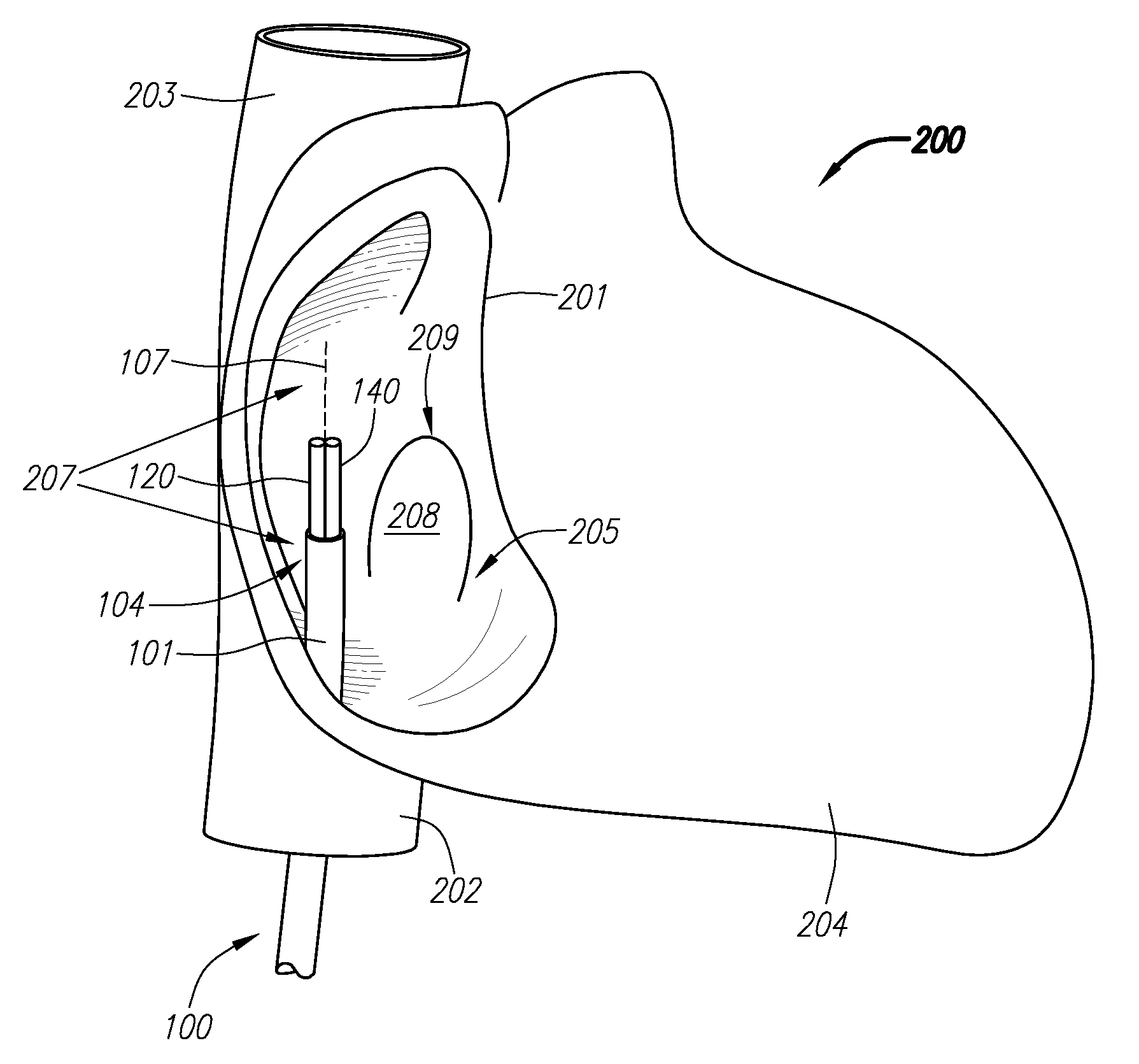 Systems and Methods for Treating Septal Defects with Capture Devices and Other Devices