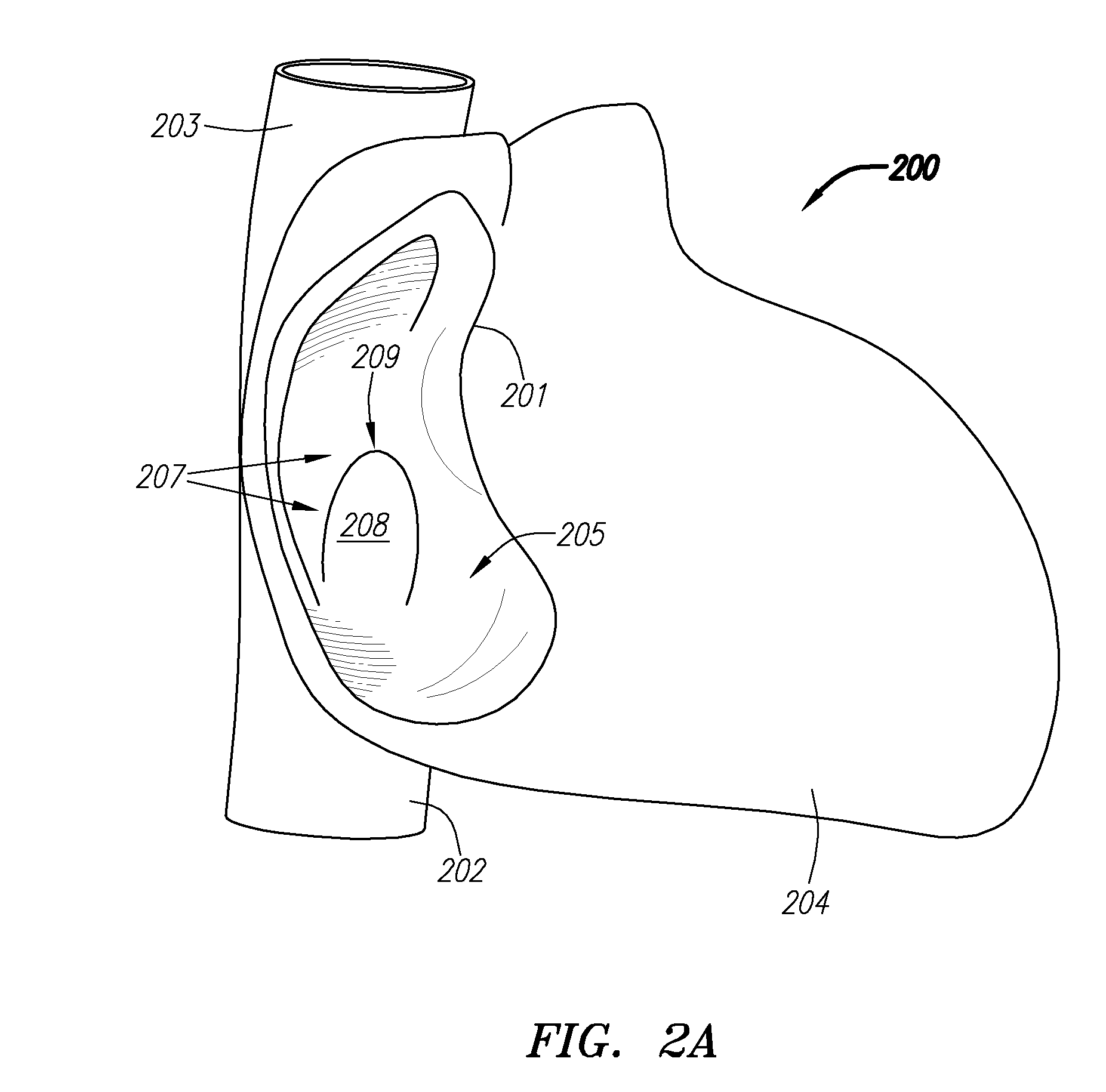 Systems and Methods for Treating Septal Defects with Capture Devices and Other Devices