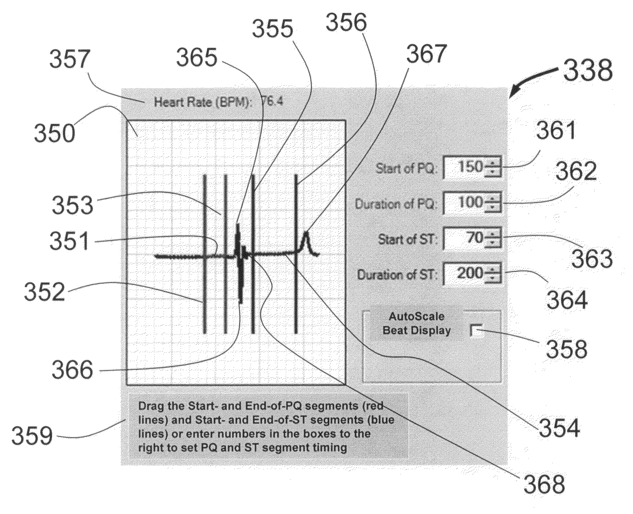 Physician's programmer for implantable devices having cardiac diagnostic and patient alerting capabilities