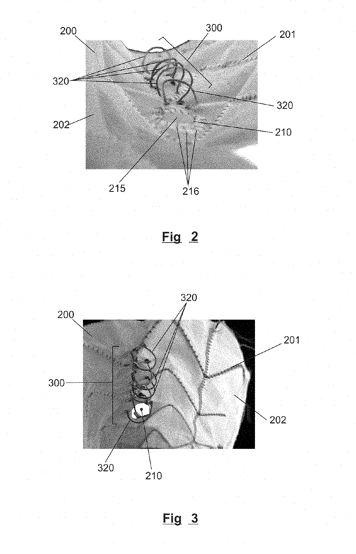 System for branches for endovascular endoprostheses and corresponding endoprosthesis for endovascular treatment of aortic aneurysms or dissections