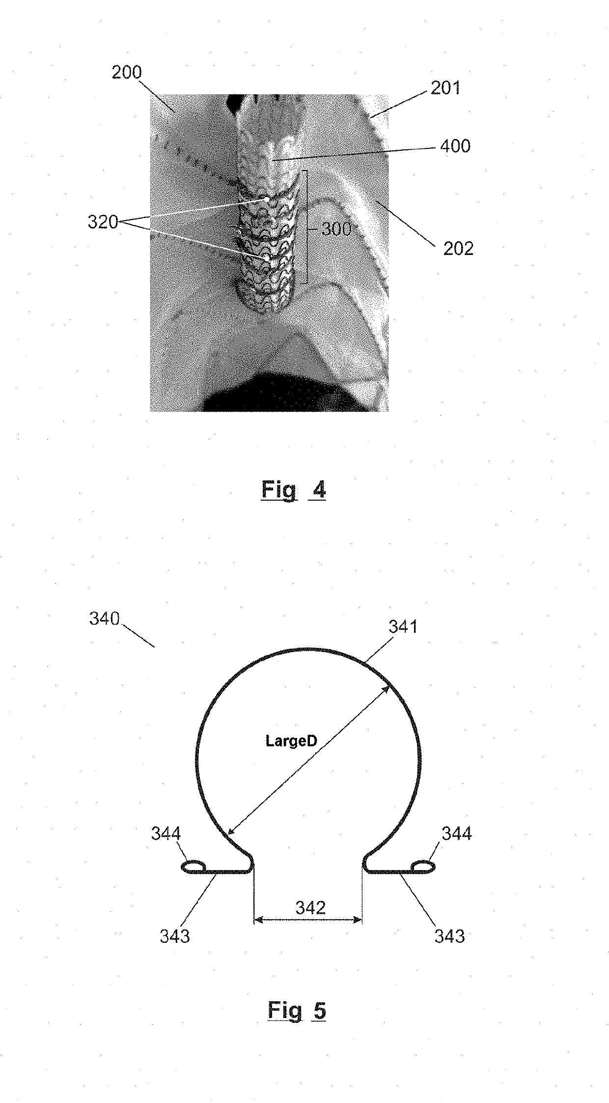 System for branches for endovascular endoprostheses and corresponding endoprosthesis for endovascular treatment of aortic aneurysms or dissections