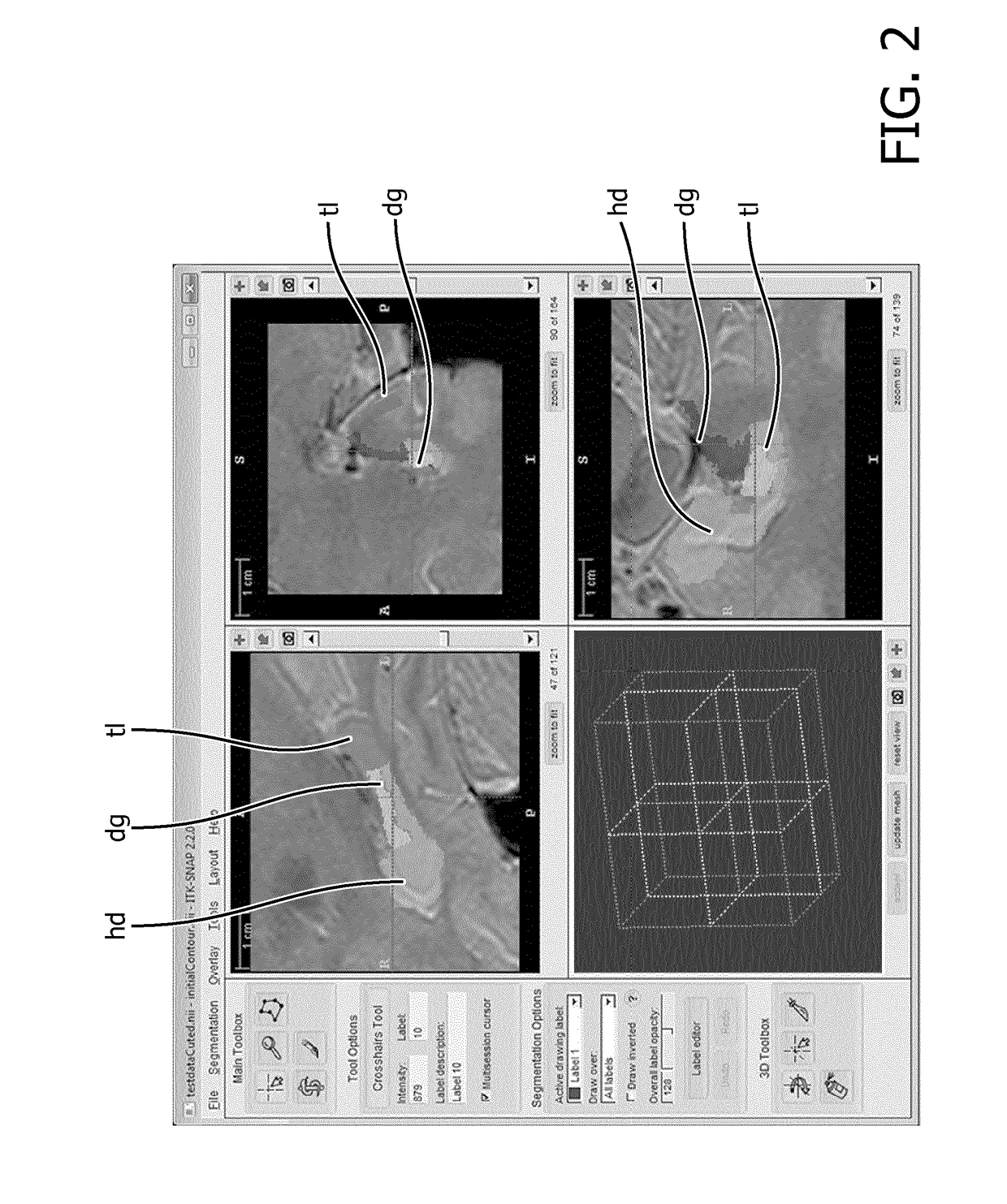 MRI protocol for segmentation of an image detail using images acquired at two different magnetic field strengths