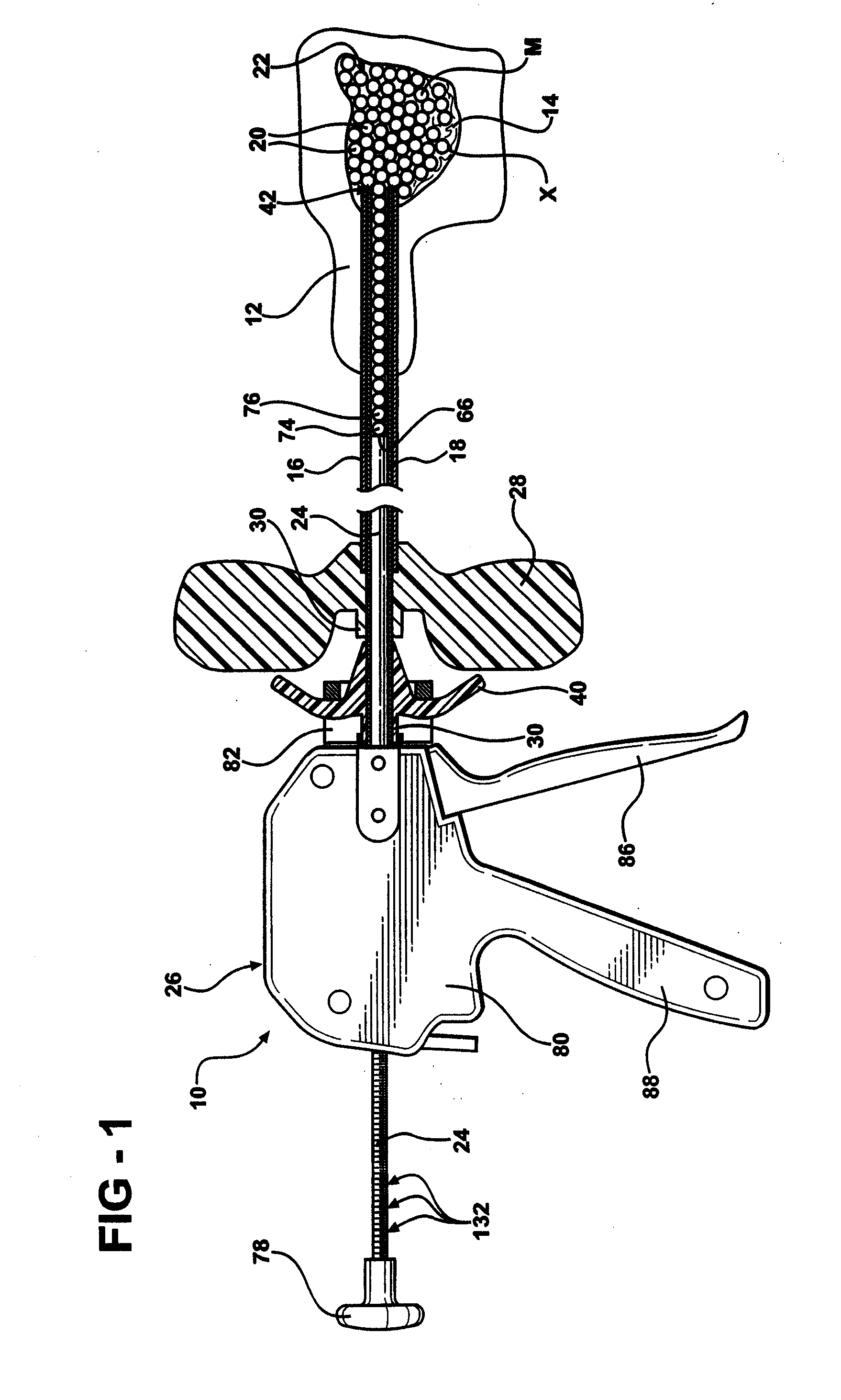 Low pressure delivery system and method for delivering a solid and liquid mixture into a target site for medical treatment