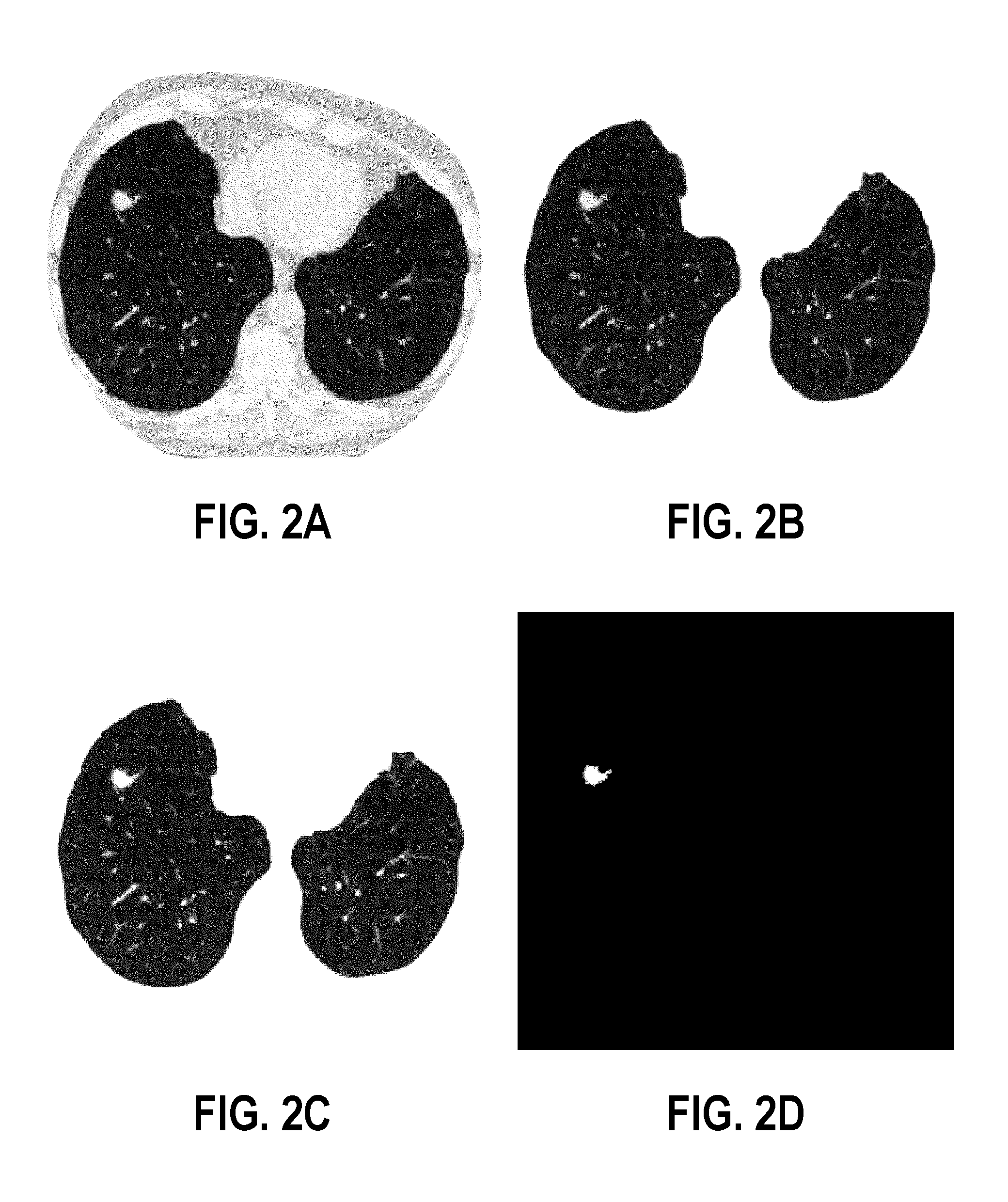 Computer aided diagnostic system incorporating appearance analysis for diagnosing malignant lung nodules