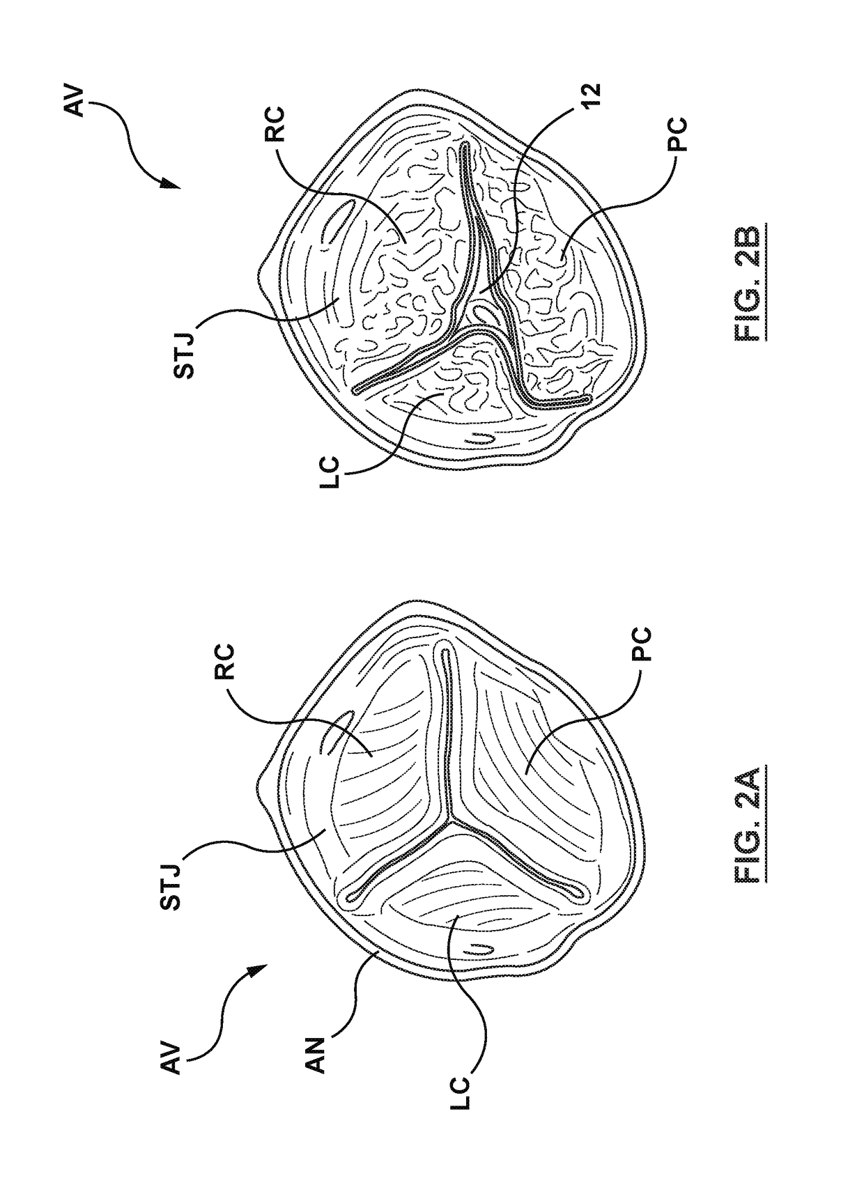 Transcatheter guidewire delivery systems, catheter assemblies for guidewire delivery, and methods for percutaneous guidewire delivery across heart valves