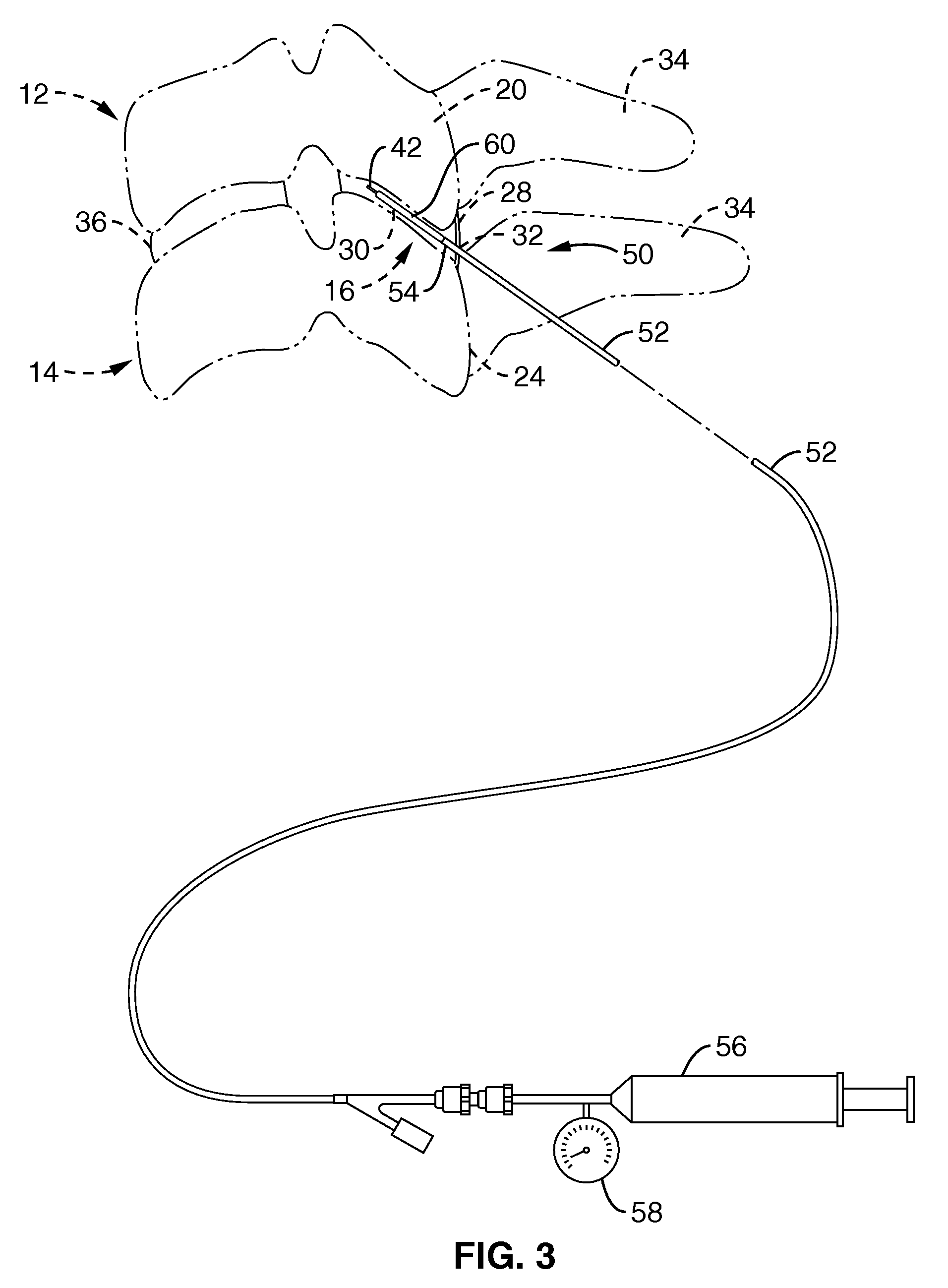 Cervical distraction device