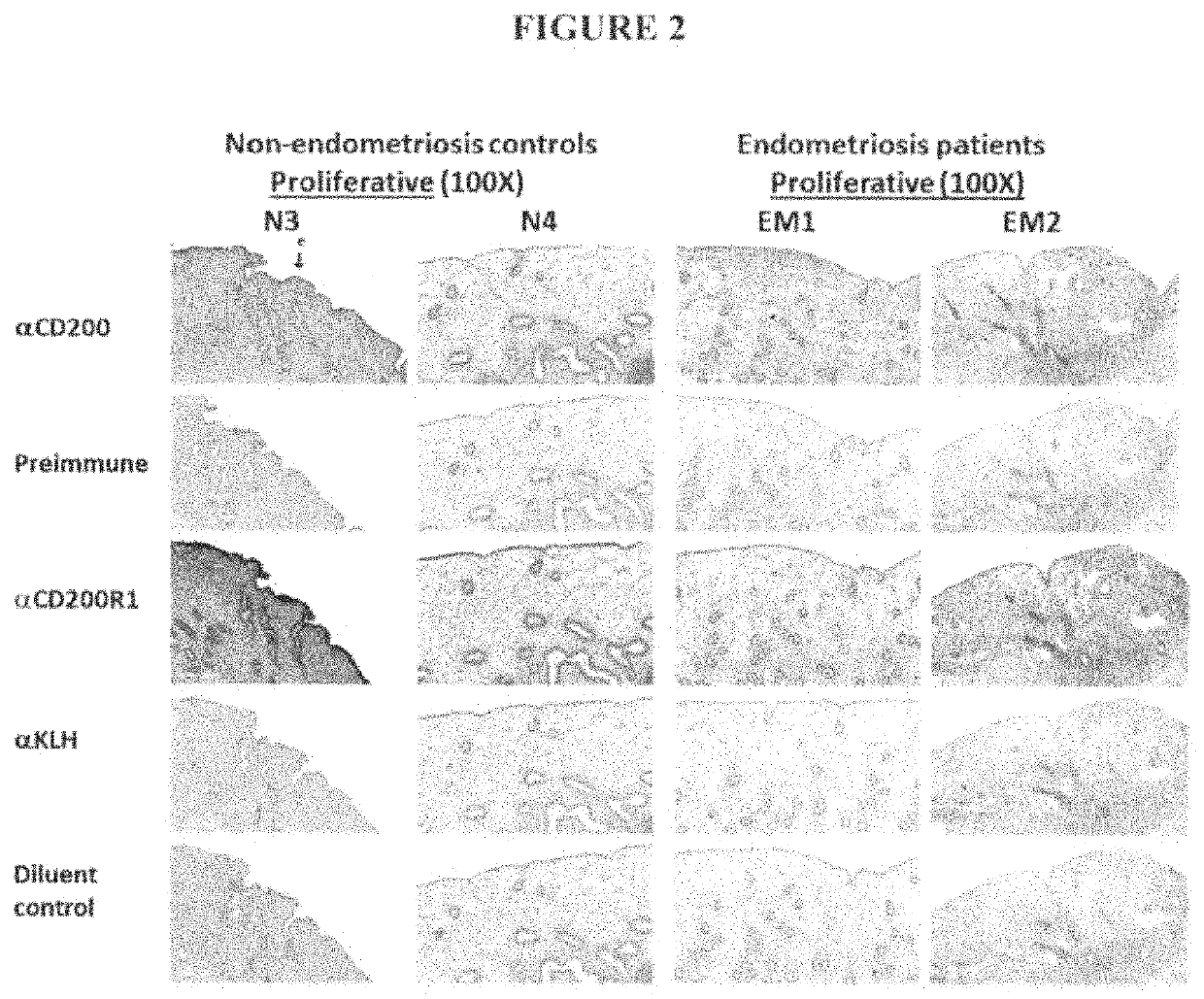 Methods for the Diagnosis and Treatment of Endometriosis