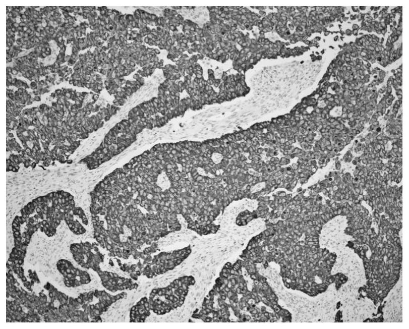 Immunohistochemical kit for rapidly identifying lung cancer and sclerotic lung cytoma during operation