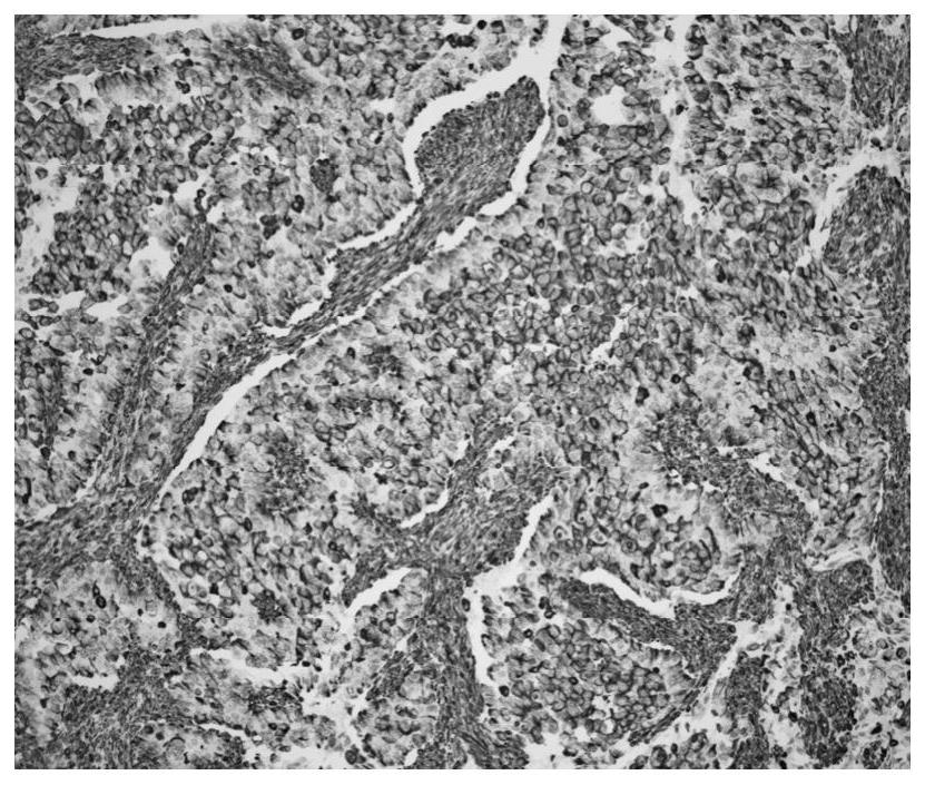 Immunohistochemical kit for rapidly identifying lung cancer and sclerotic lung cytoma during operation