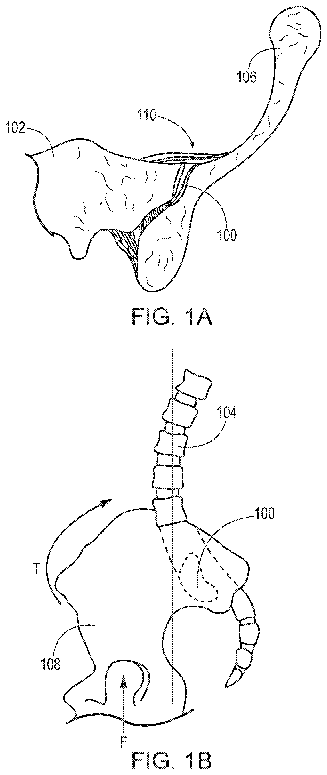 Sacroiliac joint fusion implants and methods