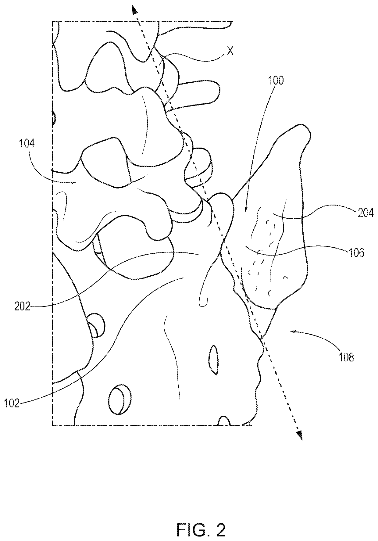 Sacroiliac joint fusion implants and methods